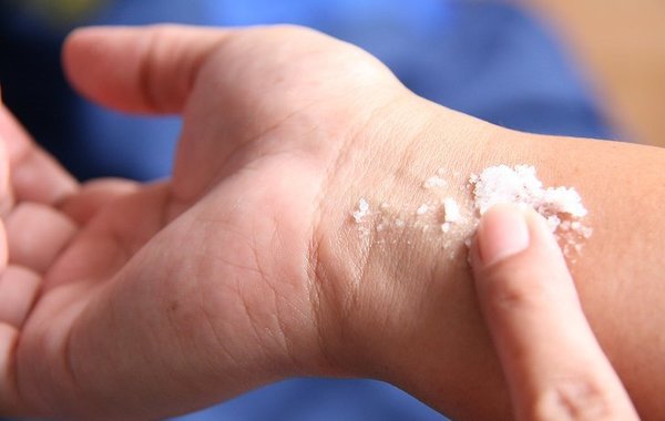 Соль облегчает дискомфорт от укуса комара
